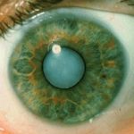 Cataract photo