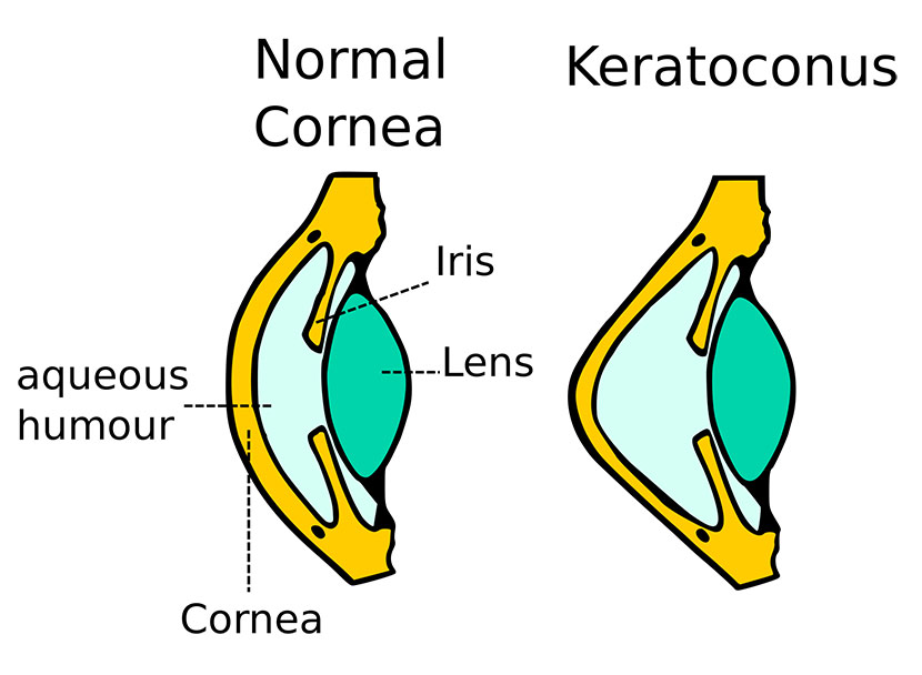 Normal Cornea / Keratoconus