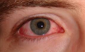 Preventing Pink Eye