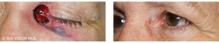 Male eyes, before and after Blocked Tear Ducts treatment, oblique view, patient 2