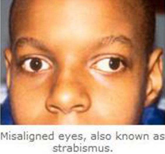 Patient eyes, before Amblyopia treatment photo, front view