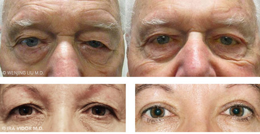 Male eyes, before and after Eyebrow Lift treatment, front view, patient 1