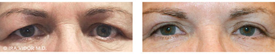 Male eyes, before and after Blocked Tear Ducts treatment, front view, patient 2