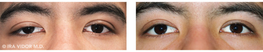Male eyes, before and after Dry Eye treatment, front view, patient 3