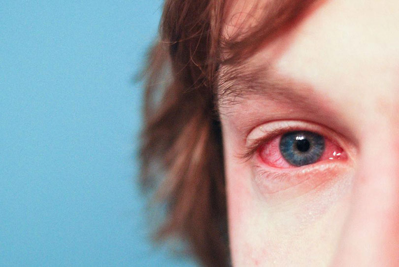 Treating Eye Allergies