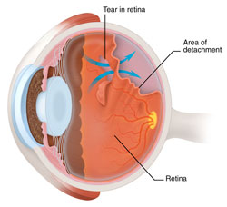 Retinal detachment - eye, scheme 2