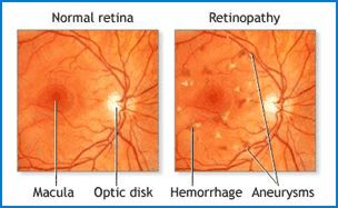 Diabetes - Normal retina / retinopathy