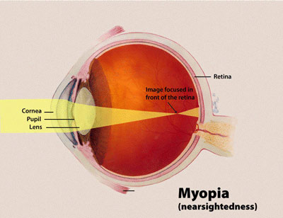 Myopia Treatment - eye scheme